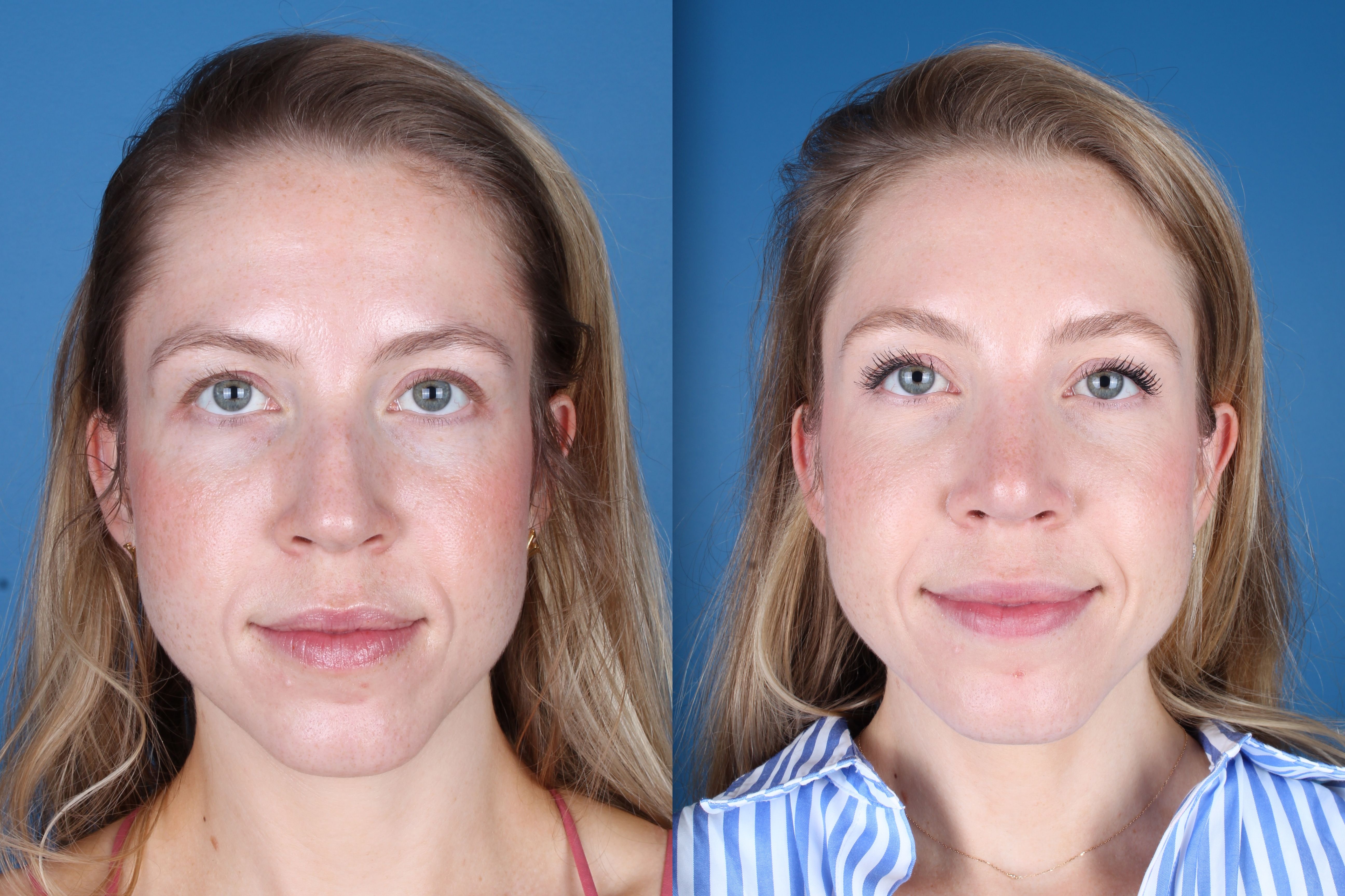 Denver Rhinoplasty Before And Afters Raval Facial Aesthetics